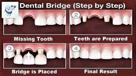 Dental Bridge Procedure