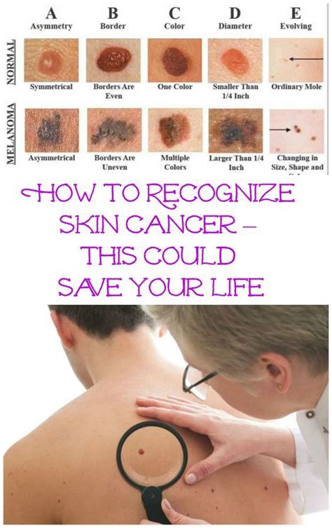 How To Recognize Skin Cancer This Could Save Your Life | Health tips, Skin cancer awareness ...