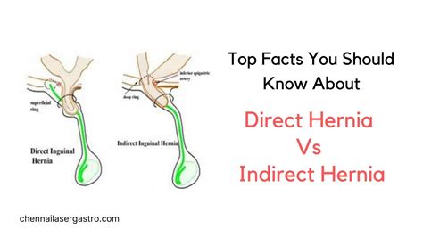 Is this direct or indirect inguinal hernia? : r/Hernia