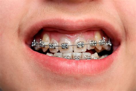 Metal Braces Advantages and Disadvantages - Braces or Invisalign