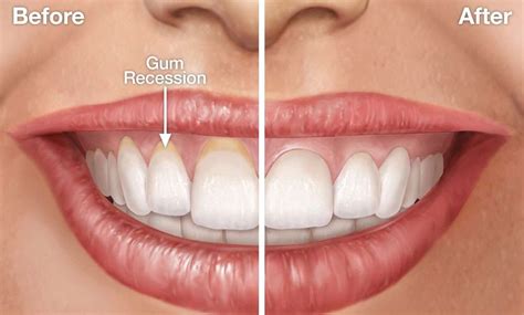 Do You Have Receding Gums?