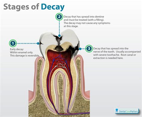 Tooth decay signs from your Redcliffe Dentist - John Street Dental Redcliffe