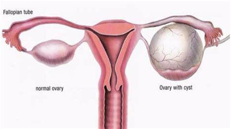 Ovarian Cyst Types - Symptoms, Pain, Diagnosis & Treatment