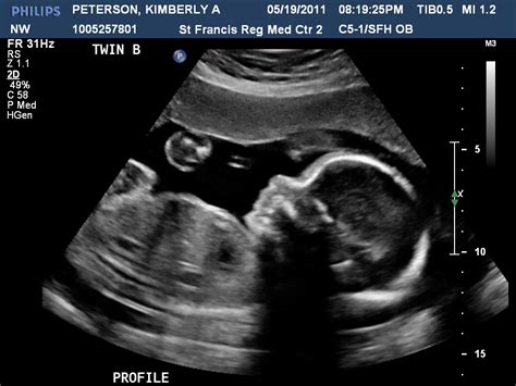 Peterson Family : 24 week ultrasound pictures