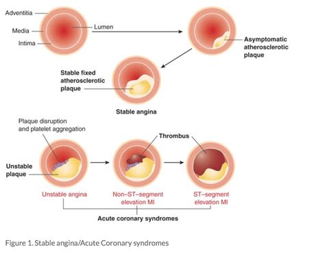 In (Gasp) Defense of the Coronary Stent – The Health Care Blog