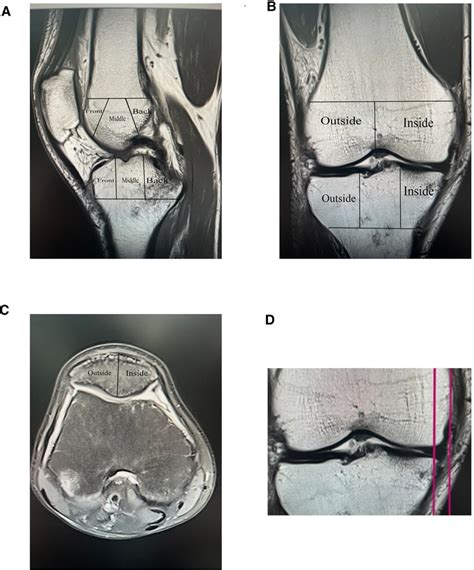 Rheumatoid Arthritis Knee Mri