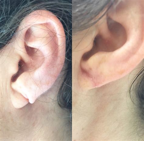 A Young Woman Professional And Her Ear Lobe Deformity Repair | Facial Beauty