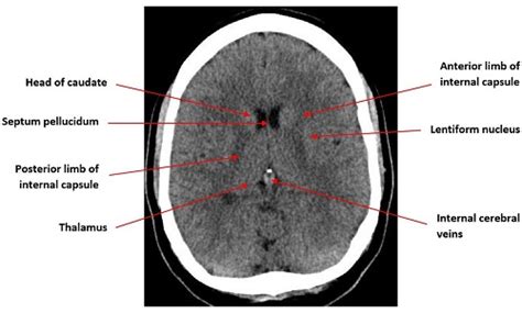 How to interpret an unenhanced CT Brain scan. Part 1: Basic principles of Computed Tomography ...