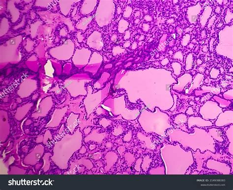 Synovial Sarcoma Histology Image Analyzed By Stock Photo 2149388383 | Shutterstock