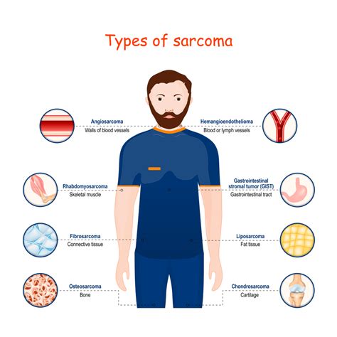 Soft Tissue Sarcoma - Travocure