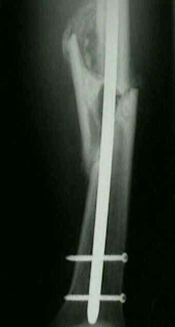 Complications of Femoral IM Nailing : Wheeless' Textbook of Orthopaedics