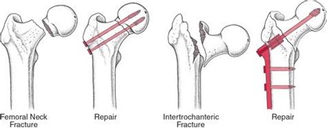 Hip Fracture Treatment Las Vegas | Patient Guide To Hip Fractures