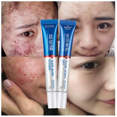 ISILANDON Face Care Clear Vanishing Acne Treatment Cream+Acne Scars Repairing Skin Repair Face ...