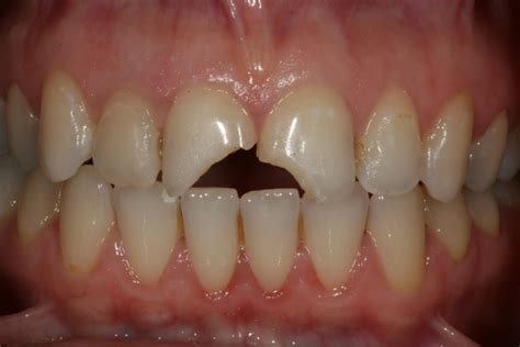 Avoid Cutting the Cingulum from Anterior Teeth | CDOCS