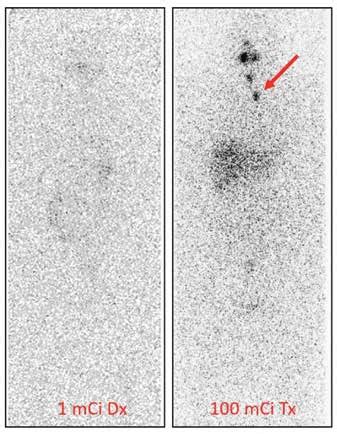 Radioactive iodine (RAI) scan with 1 mCi versus 100 mCi demonstrating... | Download Scientific ...