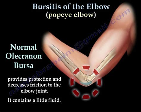 Elbow Pads For Olecranon Bursitis Purchase Wholesale | dpise2022.dps.uminho.pt