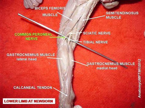 Peroneal nerve paralysis - Wikipedia