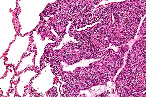 Synovial sarcoma - Simple English Wikipedia, the free encyclopedia