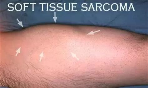 Soft Tissue Sarcoma – Way To Heal