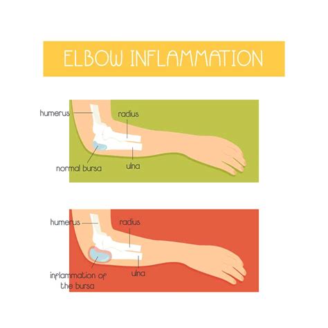 The Management and Treatment for Student’s Elbow or ‘Olecranon Bursitis’ - Prohealth365