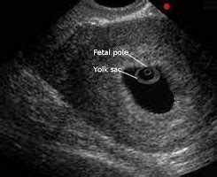 தமிழ் Fetal pole இன் அர்த்தம் — MeaningDB