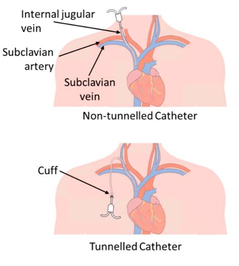 Dialysis Catheter Types