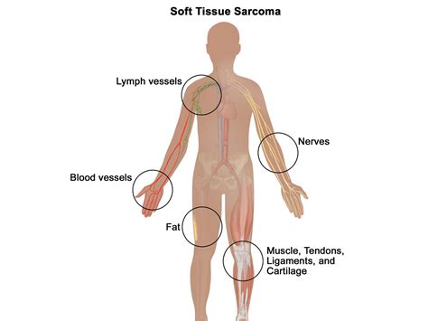 Soft Tissue Sarcoma—Patient Version - NCI