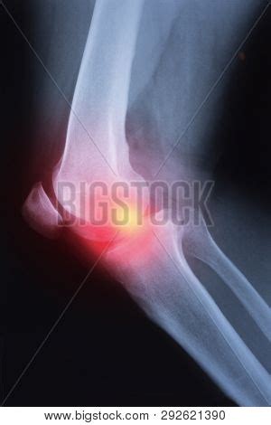 Medical X-ray Knee Image & Photo (Free Trial) | Bigstock