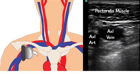 The Subclavian Line: The Resuscitation Line of Champions — Downeast Emergency Medicine