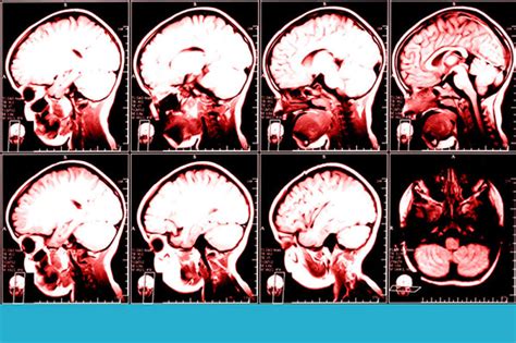 Signs Of Dementia In The Brain