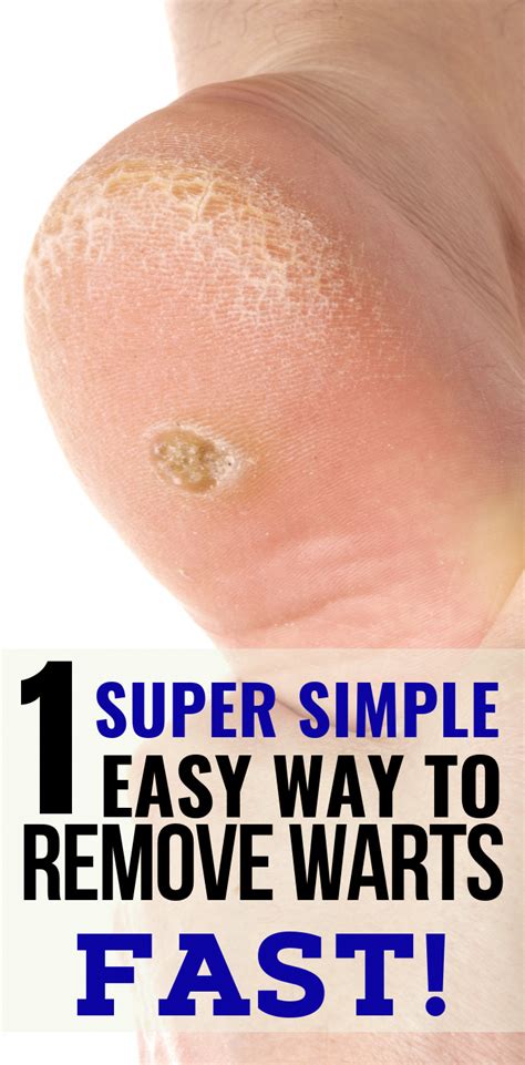 How To Remove Warts On Elbow - HOWTOREMVO