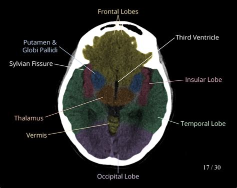 Lobes Of Brain Axial