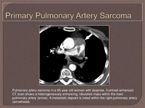 Pulmonary angiography