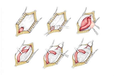 FAQ on Traditional Hernia Repair Surgery with Mesh