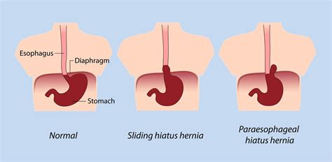 Stomach Hernia Symptoms