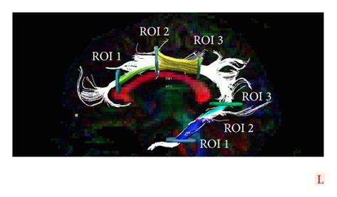 Example tract of cingulum with ROIs and tract segments. The cingulum... | Download Scientific ...