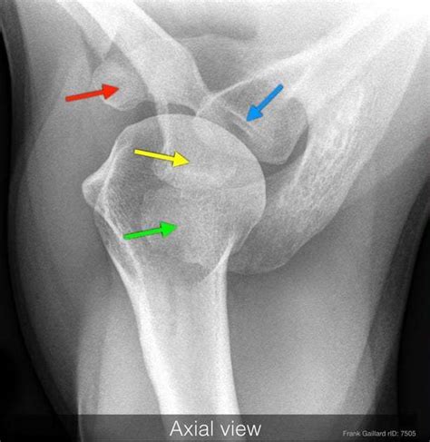 Infraglenoid Tubercle Of Scapula