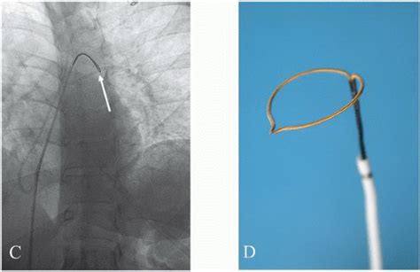 Pulmonary Angiography | Thoracic Key