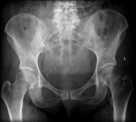 Subcapital Femoral Neck Fracture