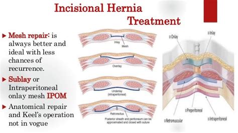 VENTRAL HERNIA