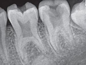 What is Taurodontism? | News | Dentagama