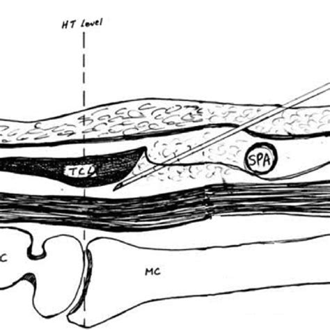 Diagram of the path of the starting 27-g needle from entry through the... | Download Scientific ...