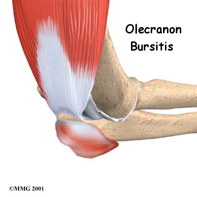 Olecranon (Elbow) Bursitis Treatment, Symptoms & Causes