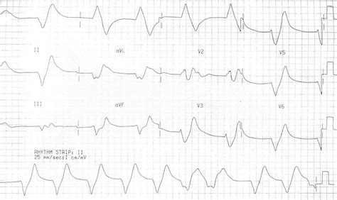 Sine Wave Hyperkalemia Ecg Changes