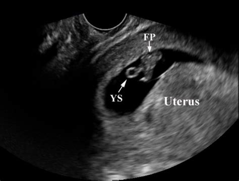 Miscellaneous (Transvaginal ultrasound of an early IUP; fetal...)