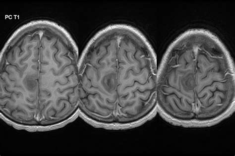 Dr Balaji Anvekar FRCR: Parietal lobe lesion on MRI