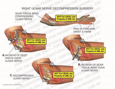 What not to do after ulnar nerve surgery? - Health Blog