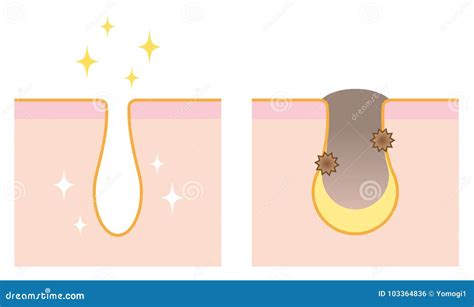 Skin Illustration of before and after Unclogging Pore Treatment Stock Vector - Illustration of ...