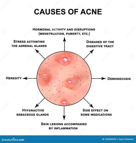 Causes of Acne. Pustules, Papules, Comedones, Blackheads, Acne on the Skin. Infographics Stock ...