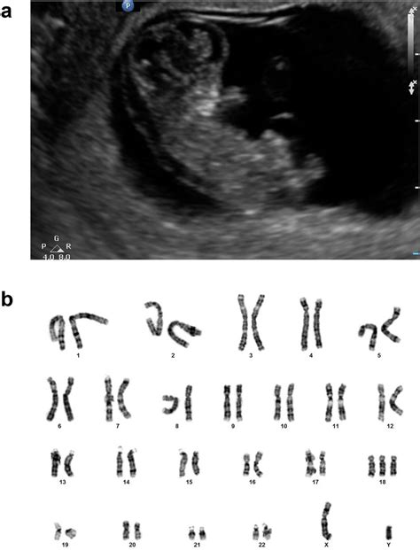 Fetal ultrasound and karyotype. (a) Ultrasound image of a trisomy 18... | Download Scientific ...